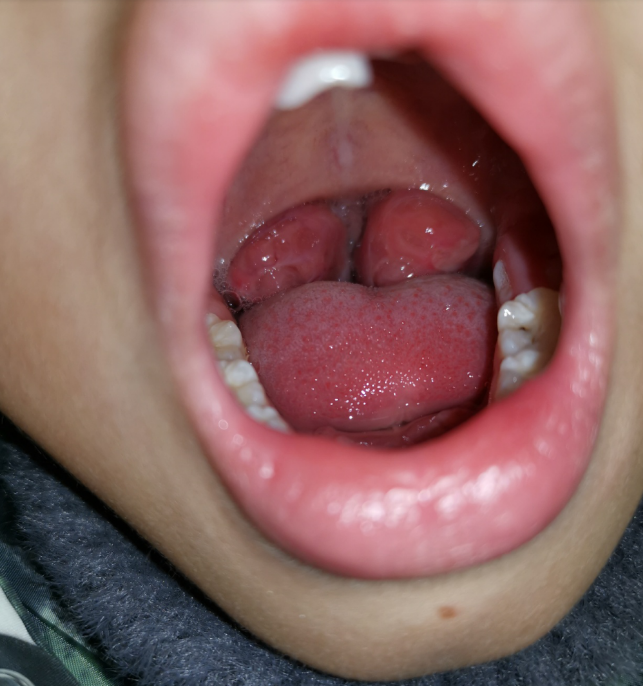 6厘米肿物堵住咽喉,7岁男童说"我的嗓子里是不是住